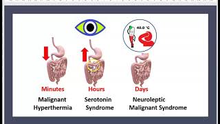 Syndrome malin des neuroleptiques Sérotoninergique Hyperthermie maligne 3 minutes [upl. by Rubie776]