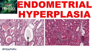 ENDOMETRIAL HYPERPLASIA  Etiopathogenesis classification Diagnosis amp treatment [upl. by Airretal200]