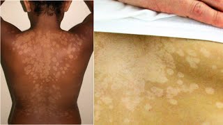 What is Tinea Versicolor Causes Treatment [upl. by Noillimaxam]