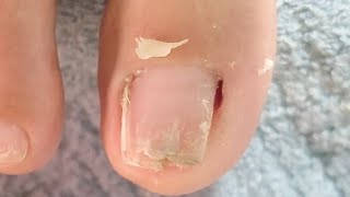 Clean up toes with nail fungus  part 85 NhaNguyenPhanThiet [upl. by Kal]