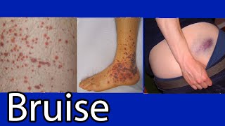 Bruise Hematoma blue spots on skin causes and treatment [upl. by Eisyak]