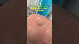 Massive Pilar cyst removal with Dr Khaled Sadek LIPOMACYST [upl. by Duthie956]