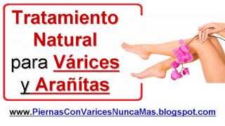 Tratamiento Natural Para Curar Las Varices y Arañitas en las Piernas  Varices Tratamiento Natural [upl. by Nevada]