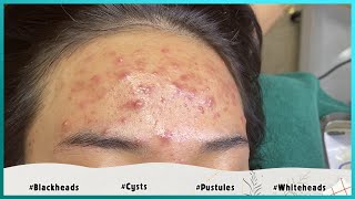 Big Cystic Acne Blackheads Extraction Blackheads amp Milia Whiteheads Removal Pimple Popping [upl. by Ilellan]