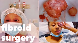 FIBROID SURGERY VLOG  open myomectomy part 1 [upl. by Aliahkim]