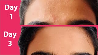 ACNE Treatment At Home  3 day Acne REMOVAL Challenge  Acne Treatment Ayurvedic with Results [upl. by Yeldud103]