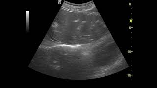 Schistosomiasis liver 주혈흡충증 간 [upl. by Sheffie596]