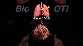 Doctor Explains PULMONARY EMBOLISM 🫁💥 [upl. by Ash]