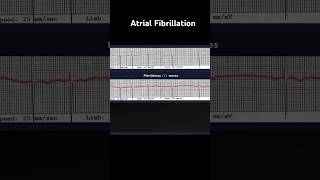 Atrial Fibrillation ECG Fibrillatory f Waves [upl. by Schweitzer]