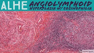 ALHE Angiolymphoid Hyperplasia with Eosinophilia 5Minute Pathology Pearls [upl. by Oijile]