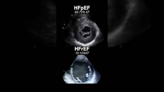 Echocardiogram HFpEF vs HFrEF radiology cardiology [upl. by Silletram]