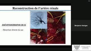 Traitement des anévrysmes de lartère rénale sans autotransplantation [upl. by Azitram562]