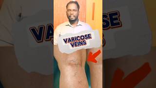 வெரிகோஸ் வெயின்ஸ் Varicose Veins youtubeshorts tamil shortsfeed [upl. by Bryce]