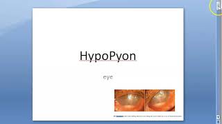 Ophthalmology 112 a HypoPyon Anterior Chamber Eye [upl. by Dallon591]