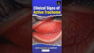 Clinical signs of active trachoma trachoma Clinicalsigns eye ophthalmology testpaperlive [upl. by Anaher]