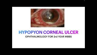 Hypopyon corneal ulcer for 3rd year MBBS students [upl. by Inger]