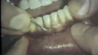 Scaling and Root Planing Part II Mandibular Teeth [upl. by Aurea]