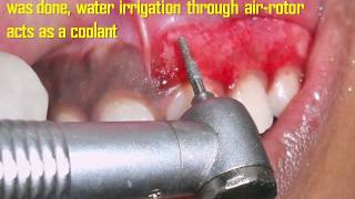 Gingival Depigmentation Procedure Using Diamond Bur Case By Dr Akash Akinwar [upl. by Killen993]