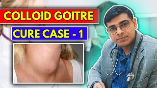 Colloid Goitre CURE Case No 1  Homeopathy Treatment for Colloid Goitre  Dr Abhik Ghosh [upl. by Ainival]