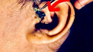 Removal of hardened earwax 😱 [upl. by Cosetta]