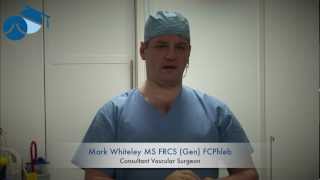 Explanation of foam sclerotherapy for varicose veins [upl. by Hanahs]