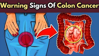 Warning Signs Of Colon Cancer You Should NOT IGNORE in 2024 [upl. by Aehtna]