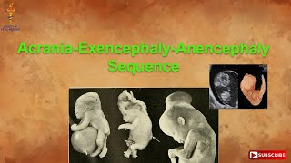 AcraniaExencephalyAnencephaly Sequence [upl. by Ahseid814]