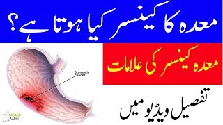 stomach cancer symptoms  stomach ulcer  ulcer information in urdu with Dr KhurramPasand Aapki [upl. by Elohc]