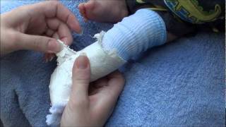 How to remove a fiberglass and plaster cast from an infant [upl. by Ayaj]