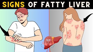 Dangerous Signs Of Fatty Liver  Dont Ignore [upl. by Marpet32]