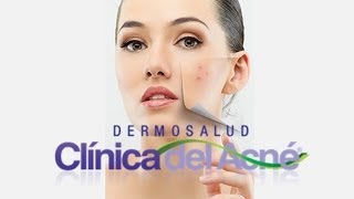 Roacutan o Isotretinoina sus Efectos Secundarios en Tratamiento para el Acne en Bogota [upl. by Pauletta466]