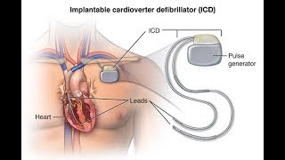 ICDS Implantable CardioverterDefibrillators PACE CARDIOLOGY [upl. by Olwena667]