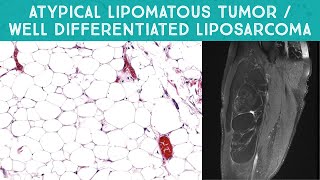 Well differentiated liposarcoma  quotAtypical lipomatous tumorquot mimicking lipoma Oregon Case 13 [upl. by Uyekawa761]