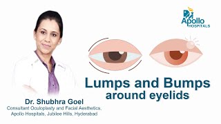 Lumps amp Bumps around Eyelids  Dr Shubhra Goel  Apollo Hospital [upl. by Debor]