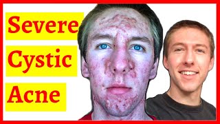 Cystic Acne Skin Clearing Transformation  10 Month Timelapse [upl. by Attevaj504]