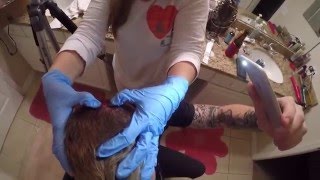 At Home Pilar Cyst Removal [upl. by Arraes44]