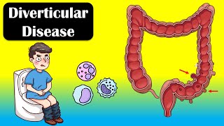 Diverticular Disease And Diverticulitis  Causes Signs amp Symptoms Diagnosis Treatment [upl. by Nillek]