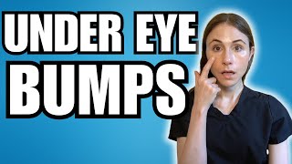 What Are Those Bumps Under The Eyes  Dermatologist Explains [upl. by Frederik]