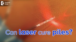 Can piles or hemorrhoids be treated with laser All about Laser Piles Surgery  Dr Rajasekhar M R [upl. by Cristin693]