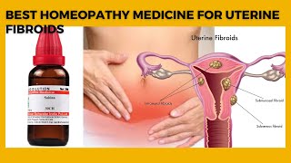 Homeopathic medicine for uterine fibroids uterine fibroid treatment without surgery [upl. by Thea140]