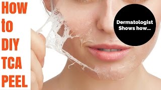 How to TCA peel Tutorial by Dermatologist [upl. by Ttennaej498]