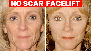 Scarless Facelift  Plastic Surgeon Explains [upl. by Chrystal]