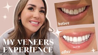 MY VENEERS EXPERIENCE  BEFORE AND AFTER WAS IT WORTH IT [upl. by Elonore]