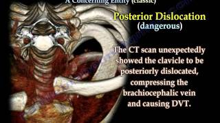 Posterior Dislocation Sternoclavicular ClassicEverything You Need To Know  Dr Nabil Ebraheim [upl. by Einhorn]