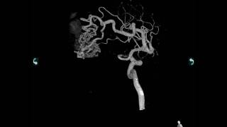 ArterioVenous Malformation AVM [upl. by Eniahs]