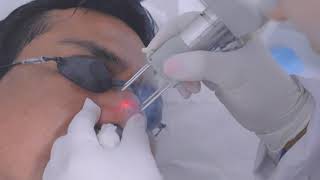 Trujillo Peru Laser co2 Fraccionado DEKA para Hiperplasia Sebácea  Estetica [upl. by Volpe]