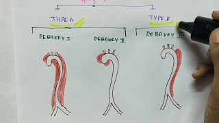 Aneurysms and Aortic dissection  Pathology  Handwritten notes [upl. by Crysta]