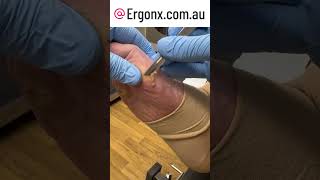 Punch callus removal from foot by podiatrist with scalpel [upl. by Tloc]