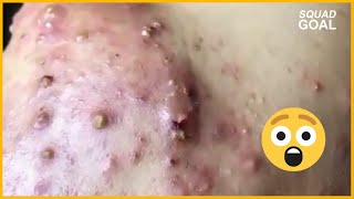 Removal Blackheads On The Face Acne Vulgaris [upl. by Ruiz974]