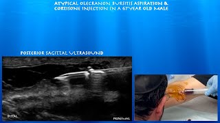 Ultrasound Guided Atypical Olecranon Bursitis Aspiration and Cortisone Injection by probeultrasound [upl. by Wunder]